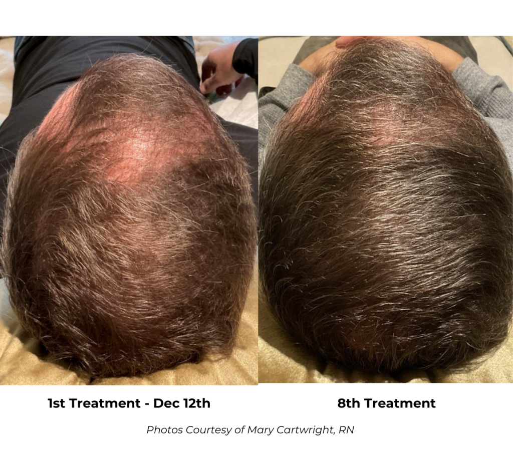 CryoTouch™ MD - 1st & 8th Treatment