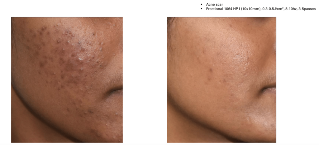 Picolo Premium laser treatment for skin