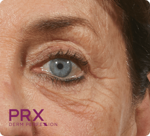PRX Derm Perfexion Treatment