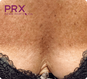 PRX Derm Perfexion Treatment