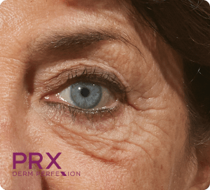 PRX Derm Perfexion Treatment