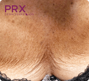 PRX Derm Perfexion Treatment