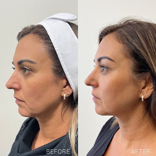 Sylfirm X RF microneedling before and after treatment